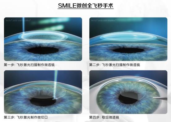 全飞秒SMILE手术_副本